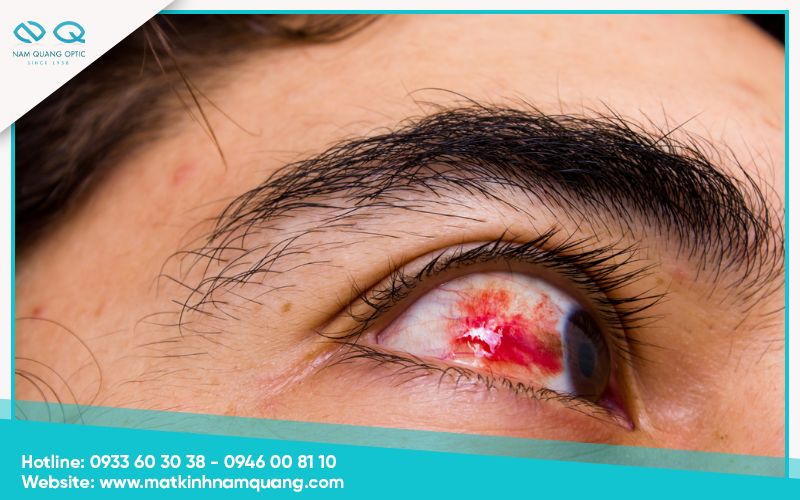 Xuất huyết dưới kết mạc