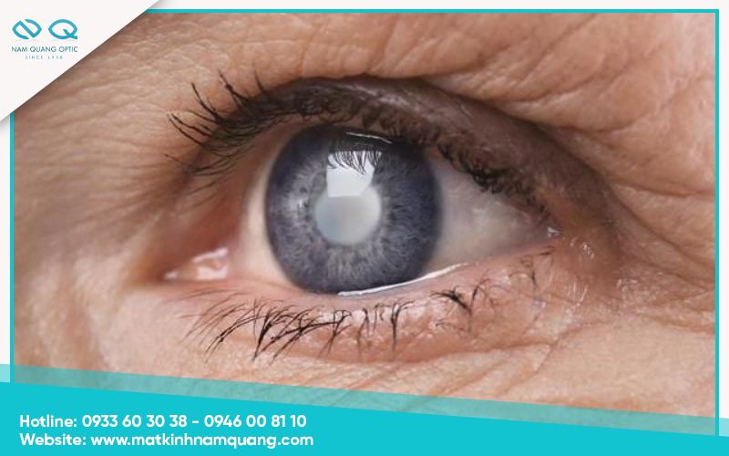 Đục thủy tinh thể