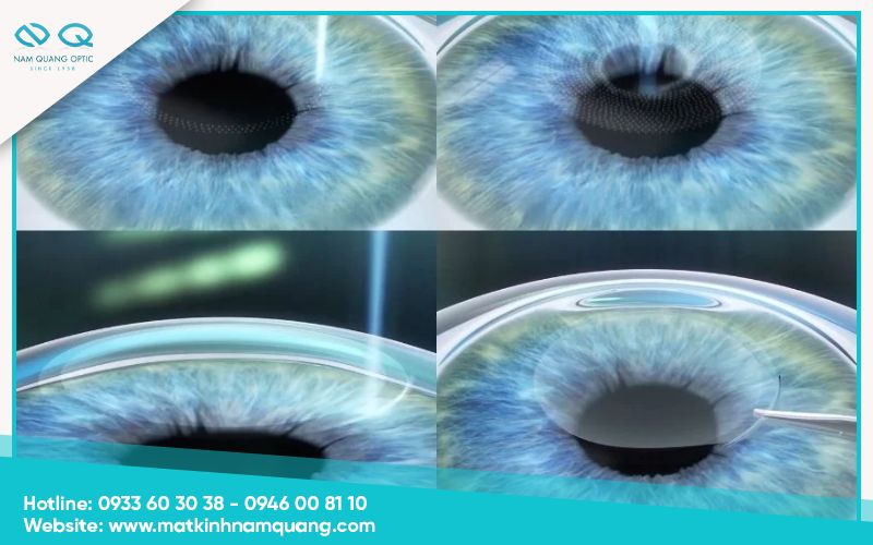 ReLEx SMILE: Công nghệ không tạo vạt hiện đại