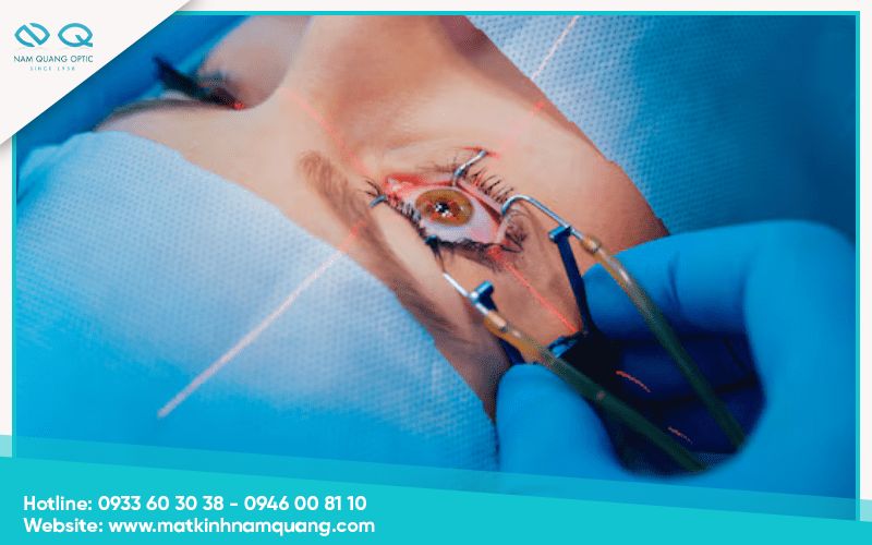 Những lưu ý quan trọng sau khi mổ mắt cận thị