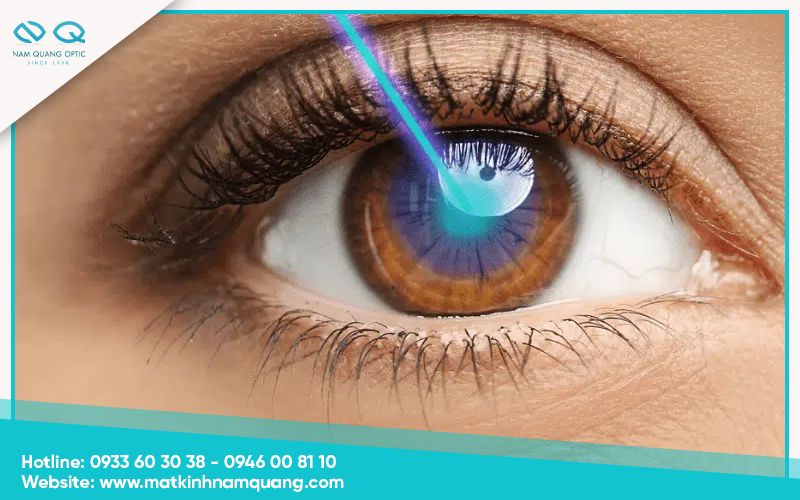 Những điều cần biết trước khi mổ mắt cận thị