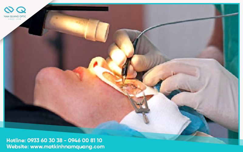 Mổ mắt cận là gì?