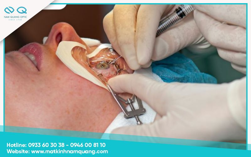 Các yếu tố quyết định mức độ rủi ro khi mổ mắt cận thị