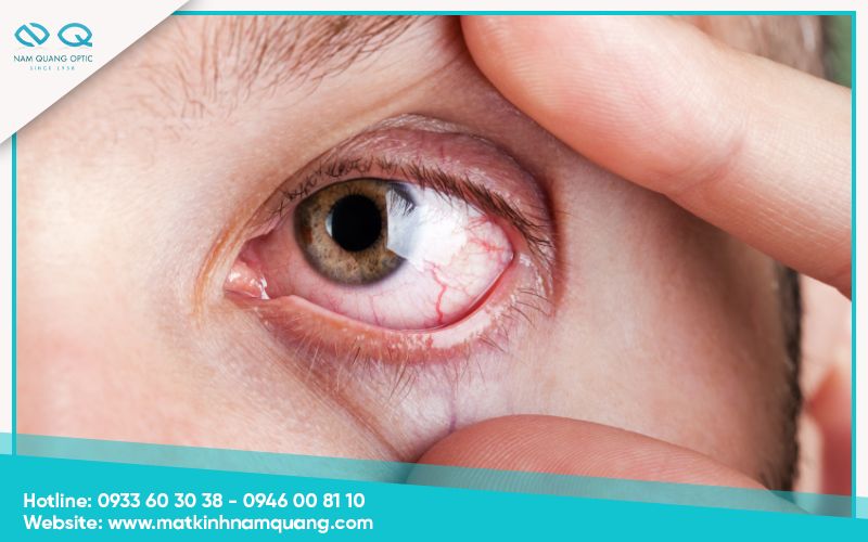 Khô mắt sau phẫu thuật