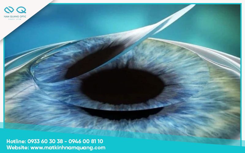 Vạt giác mạc bị lệch