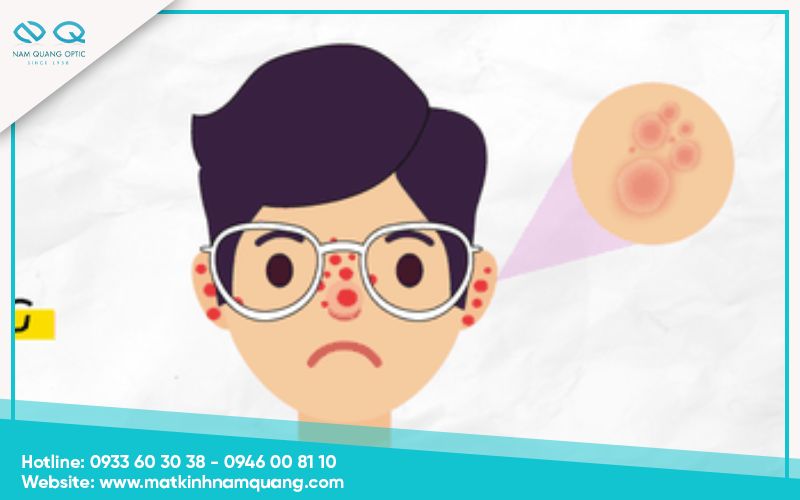 Bi-di-ung-kim-loai-deo-kinh-gi-2 Dị ứng kim loại là gì và tại sao lại xảy ra khi đeo kính?