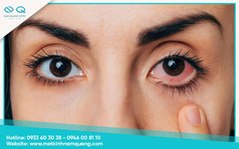 Mắt hay bị khô, rát